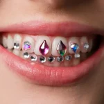 Ultimate Guide to Braces Colours