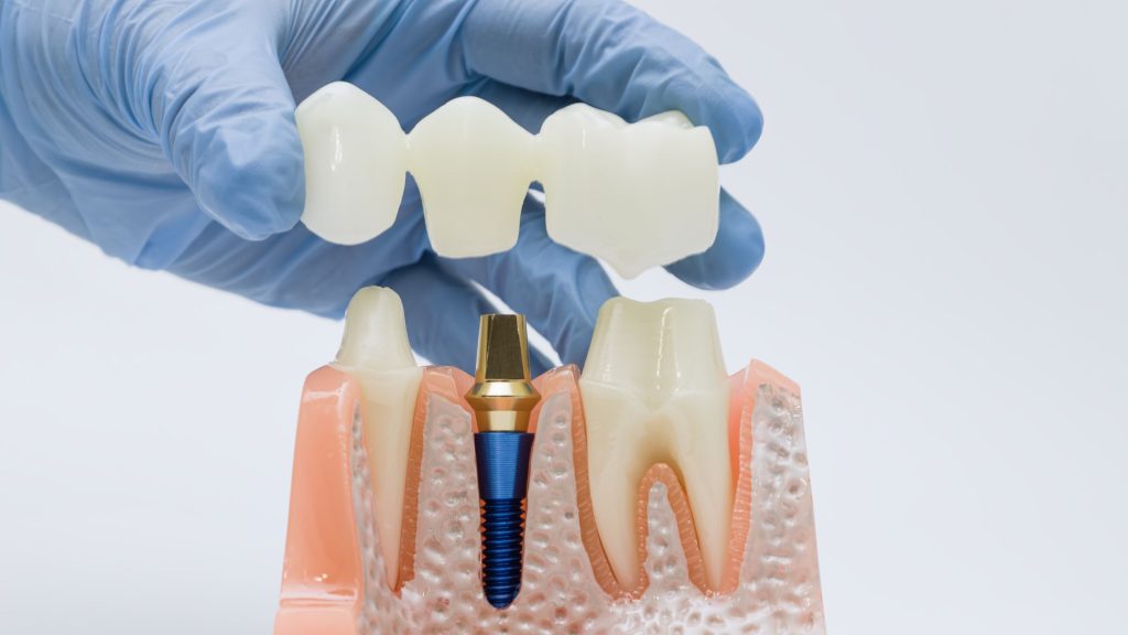 Dental Bridge