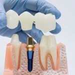Dental Bridge