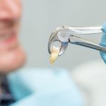 Wisdom Teeth Removal