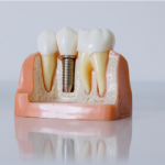 dental implant costs