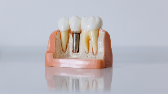 dental implant costs